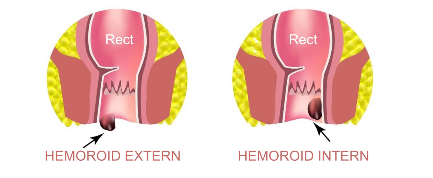 hemoroizi-interni-externi