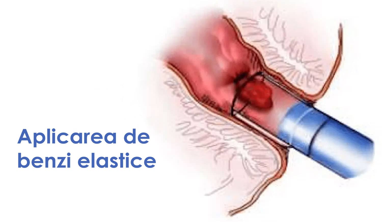 ligaturare-tratament-hemoroizi