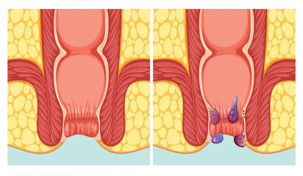 informatii-hemoroizi