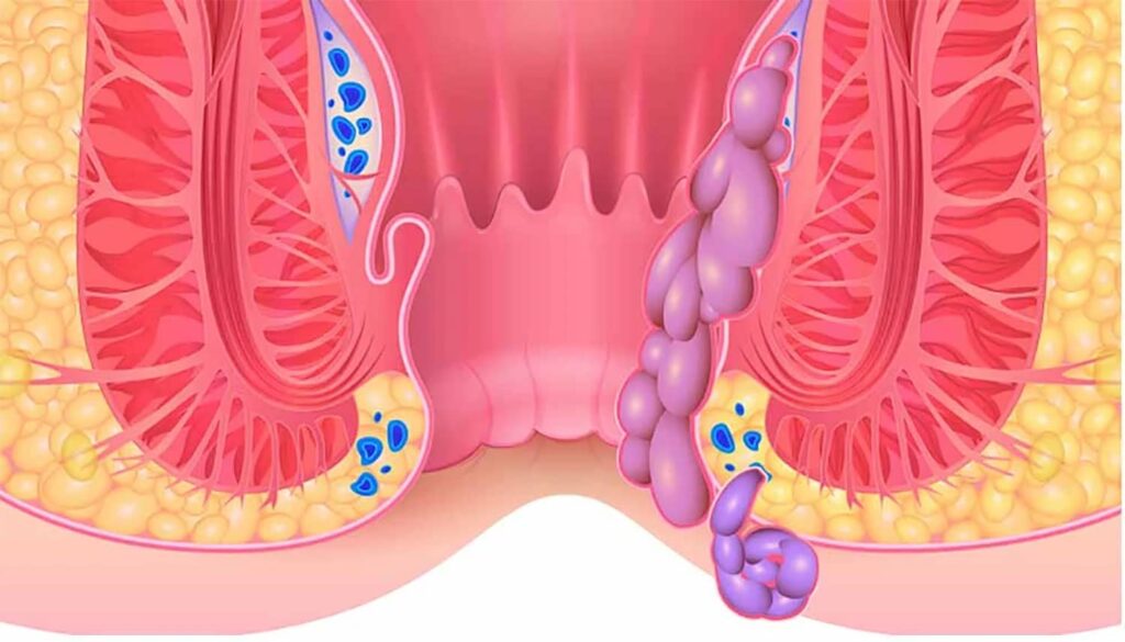 totul-despre-hemoroizi